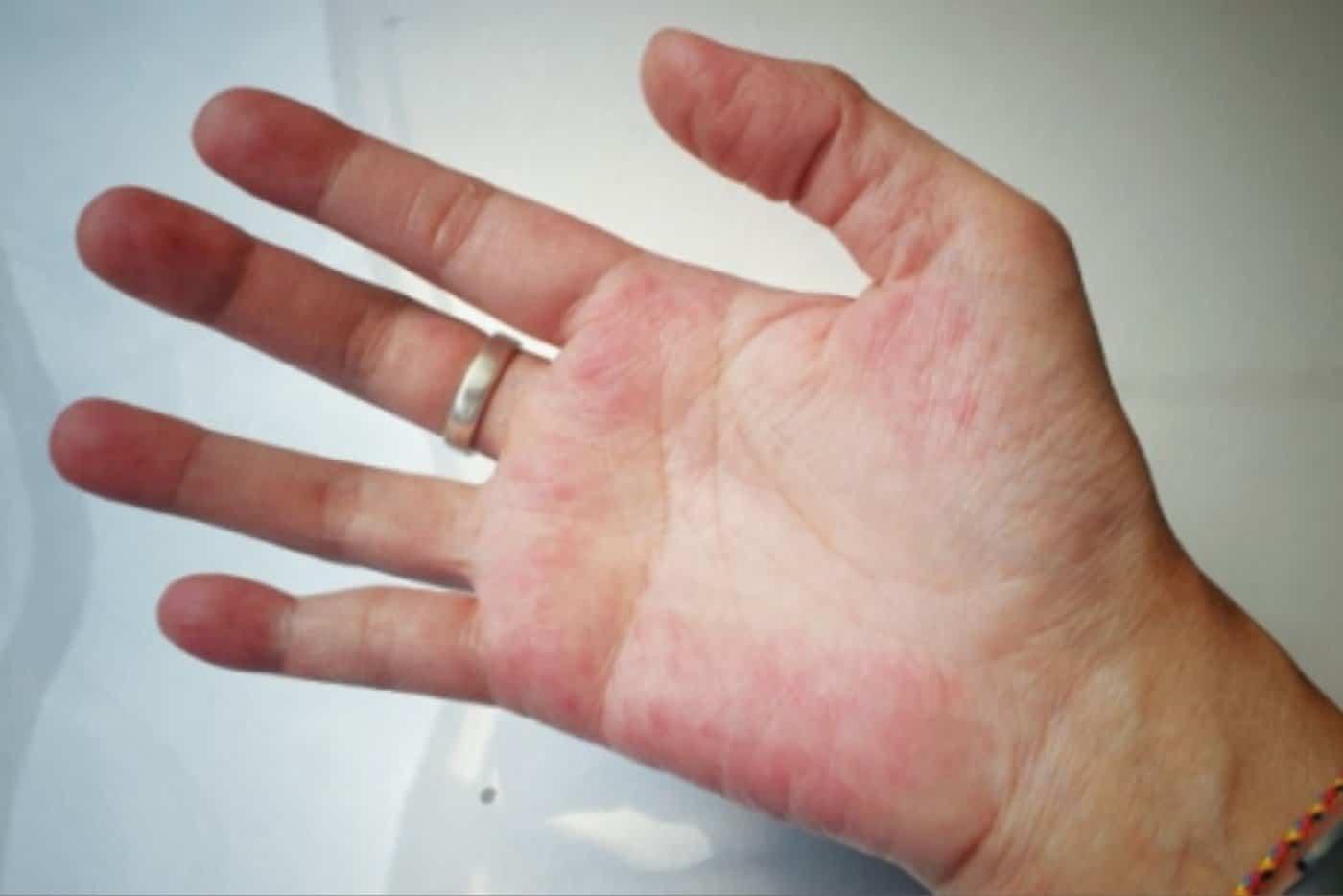 Jangan Ambil Mudah Penyakit Lupus, Rawat Cepat Atau Akan Ada Bahaya Menanti!