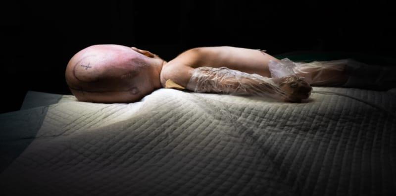 Apa Itu Kepala Besar Hidrosefalus? Ini Yang Perlu Anda Fahami