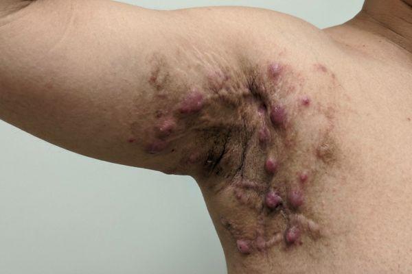 jerawat di badan