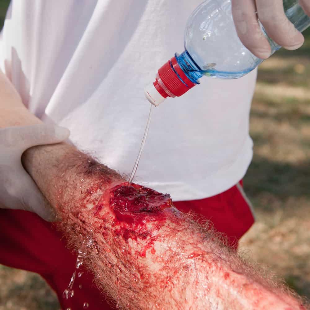 cara merawat luka melecur