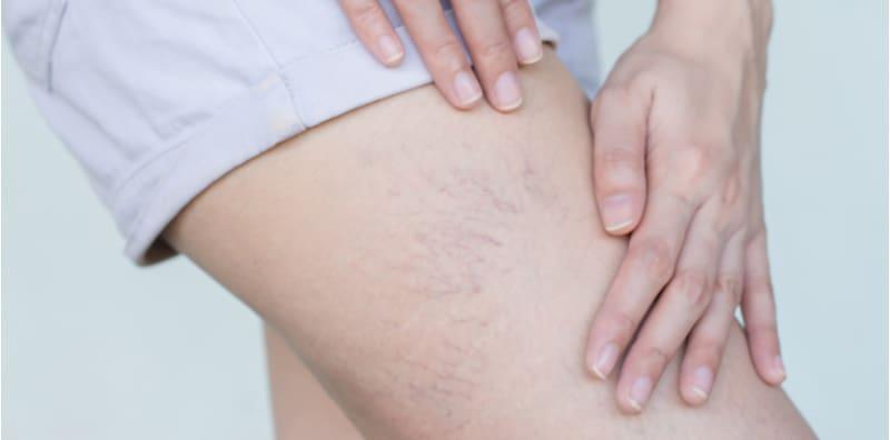 Bahaya Ada Ruam Tompokan Darah Seakan Labah-labah Di Badan! Ini Amaran Penyakit Sirosis Hati