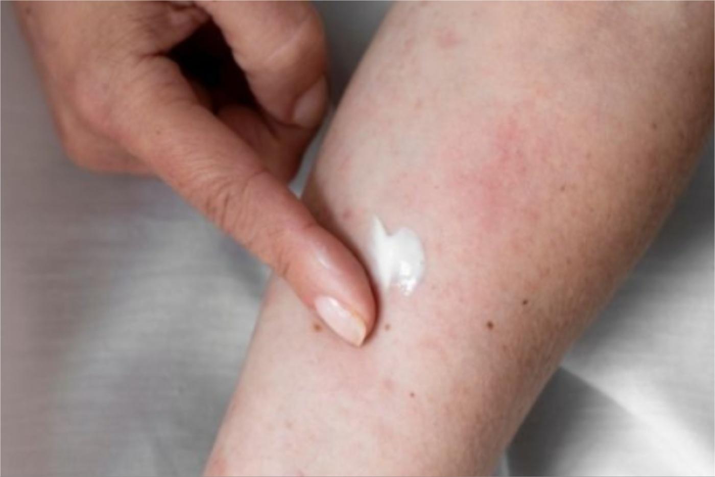 Jaga-Jaga Dengan Penyakit Kulit Berjangkit, Ini 7 Jenis Yang Anda Perlu Tahu!