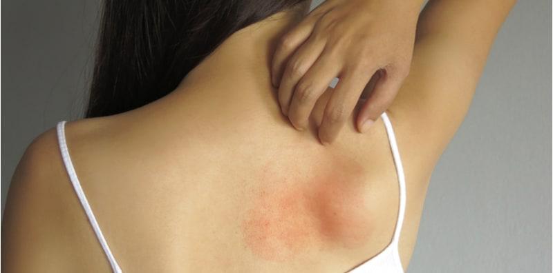 Rawat Ekzema Dengan Mandian Peluntur, Selamat Ke?