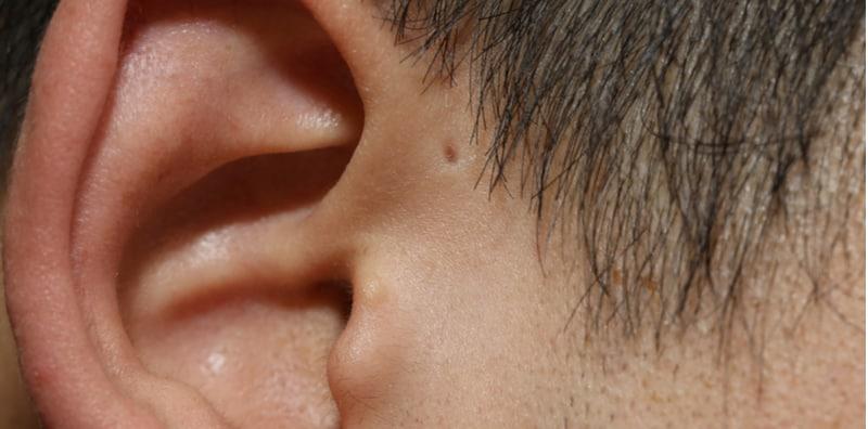 Perasan Macam Ada Lubang Kecil Di Telinga? Ia Berisiko Untuk Alami Infeksi!