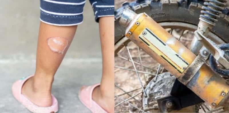 Ikut 5 Cara Pertolongan Cemas Ini Jika Kulit Melecur Kena Ekzos!