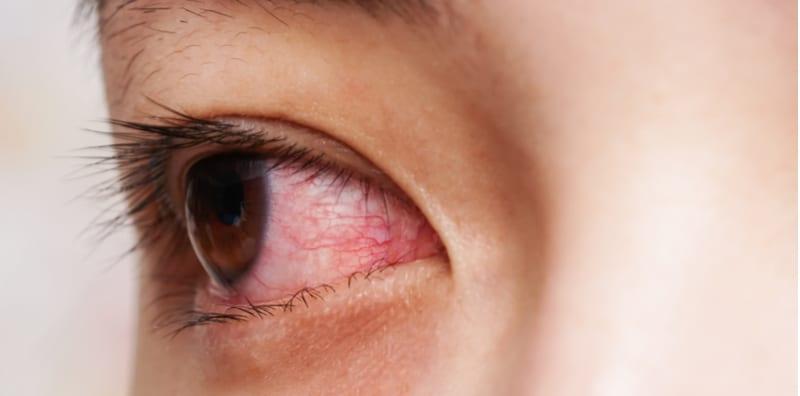 Sakit Mata Berjangkit? Ini Sebab Jangan Pandang Orang Yang Ada Keradangan Mata!