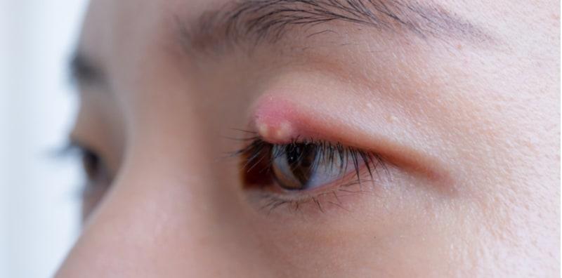 Orang Kata Mata Tumbuh Ketumbit Sebab Mengintai, Tapi Kajian Pula Buktikan Puncanya Stres?