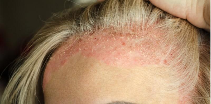 Ekzema Kepala Punca Kulit Kepala Selalu Gatal, Sampai Boleh Buat Rambut Gugur?