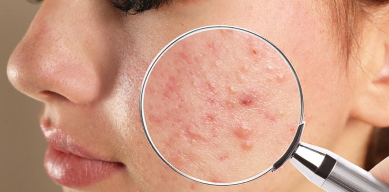 Hati-Hati Kalau Nak Ambil Pil Jerawat Ini, Kena Tahu Kesan Sampingannya Dahulu!