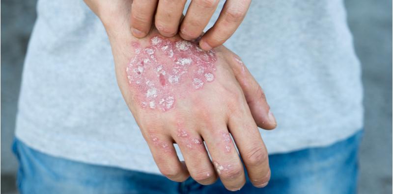 Nak Lawan Penyakit Kulit Psoriasis, Mudah Sahaja! Kuatkan Sistem Imun Badan Anda
