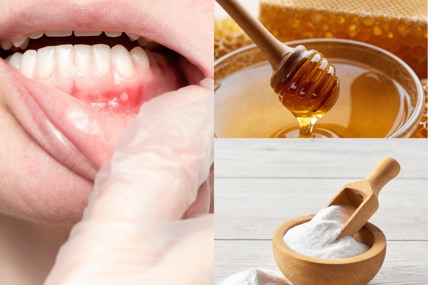 Sakitnya Bila Ada Ulser Dalam Mulut, Cuba 6 Cara Ini Rawat 'Mata Ikan' Di Rumah!