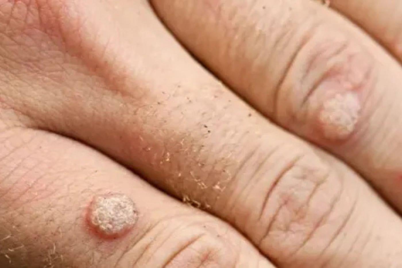 Ketuat Degil Di Jari Tak Hilang-Hilang? 5 Cara Ini Boleh Bantu Atasi Dengan Pantas!