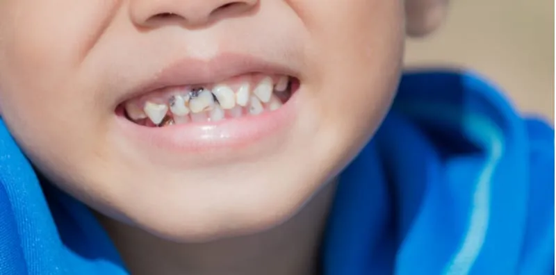 Gigi Anak Hitam & Rongak? Mak Ayah Usah Biarkan, Ini Bukan Hal Biasa Walaupun Gigi Susu