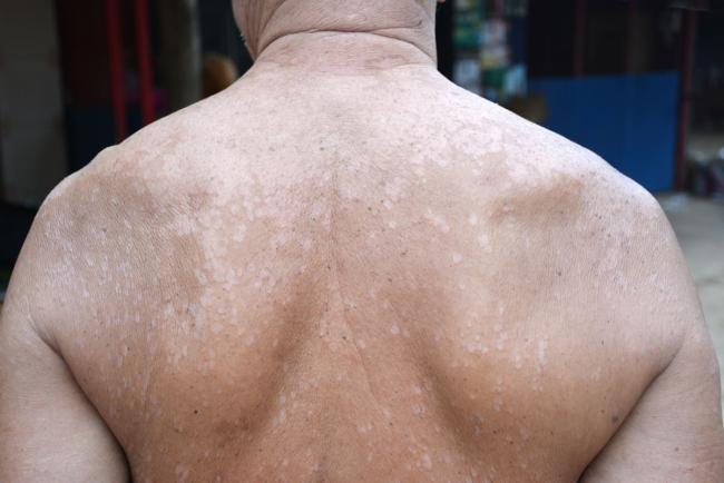 Tak Perlu Ke Klinik! 4 Cara Mudah Hilangkan Panau Di Rumah, No. 1 Paling Unik!