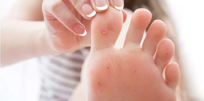 Ini Cara Nak Tahu Ketuat Yang Tumbuh Pada Badan Normal Atau Sebab Sakit Kelamin!