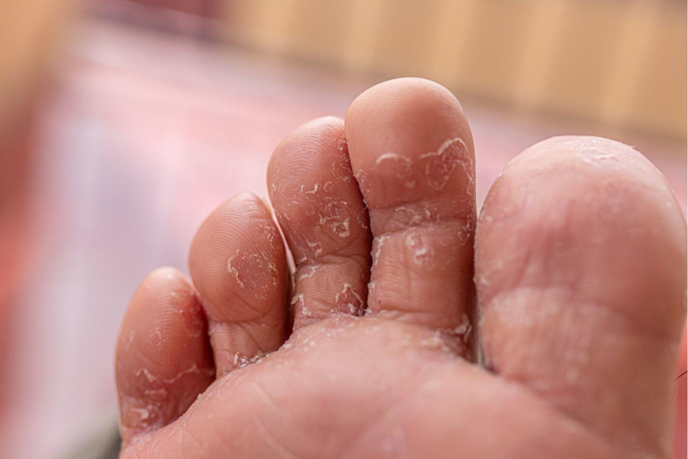 Celah Jari Kaki Mengelupas? Ini Namanya Kulat Air! Rawatnya Dengan 6 Cara Ini