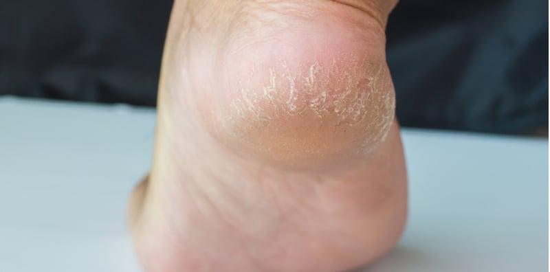 Ini Punca Tumit Merekah, Tapi Jangan Risau Sebab Ada 5 Cara Mudah Rawat!