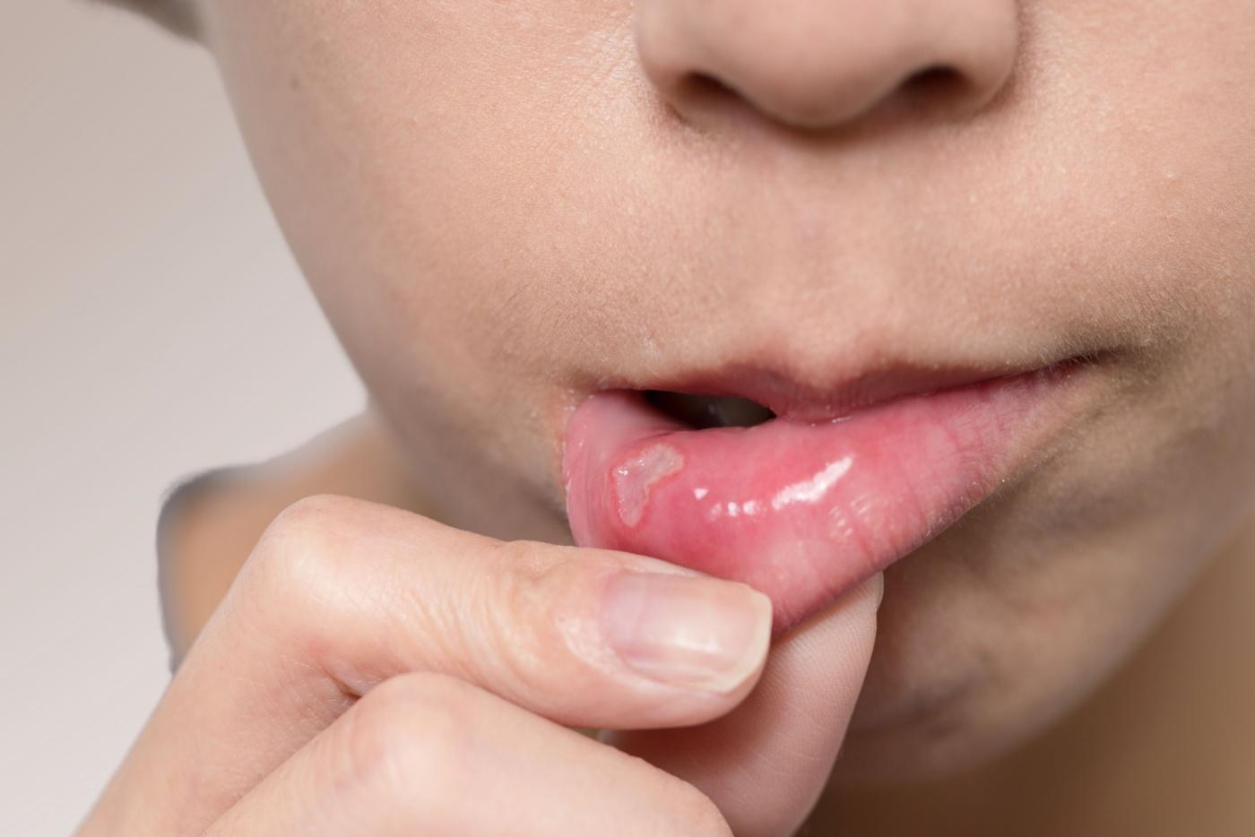 Jangan Terus Sapu Ubat Gel Bila Kena Ulser Mulut, Lagi-lagi Pada Si Kecil! Ini Sebabnya