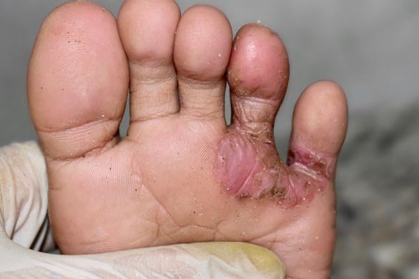 tapak kaki sakit
