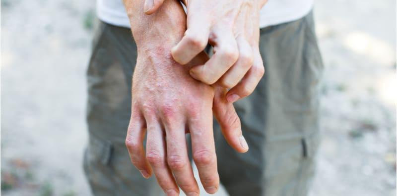 Dua-Dua Gatal, Tapi Apa Beza Kulit Dermatitis Atopik Dan Ekzema? Ini Jawapannya!