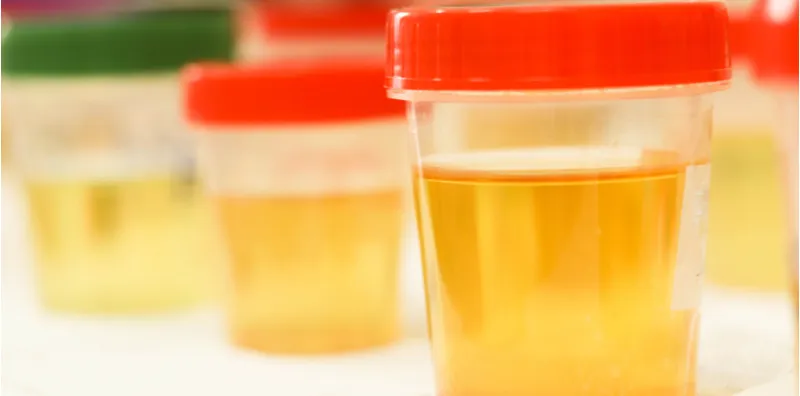 Jangan Ambil Ringan Jika Kencing Warna Pink & Berbau Busuk. Ini Adalah Tanda Batu Karang!