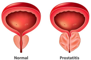 Sakit Prostat: Ini Info Lengkap Tentang Prostat Yang Anda Kena Tahu