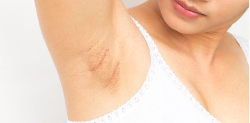 Selain Leher, Ketiak Juga Boleh Jadi Hitam Semasa Hamil, Usah Malu Ini 5 Cara Boleh Atasinya!