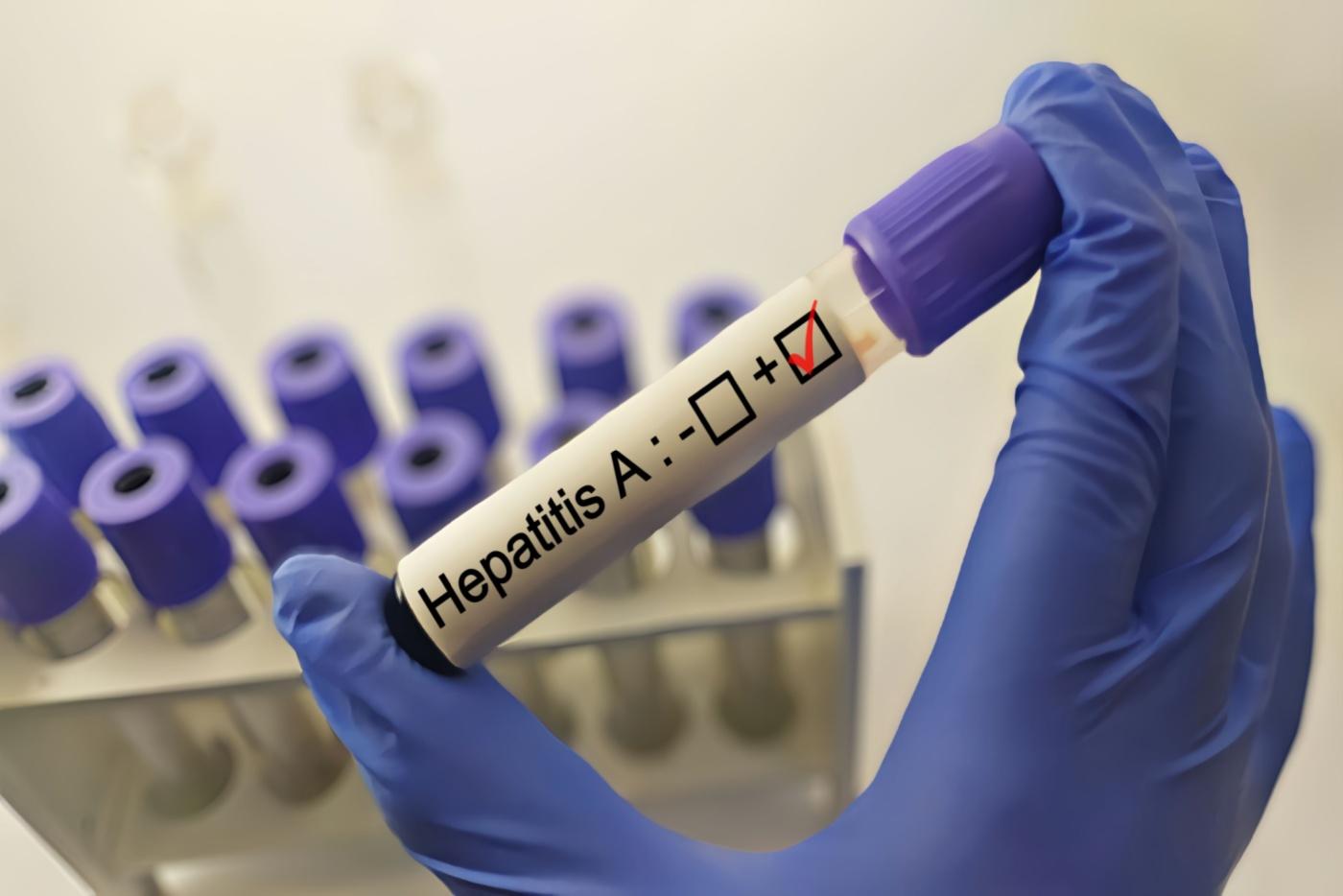 apa-itu-hepatitis-a