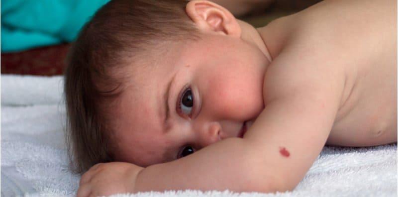 Si Kecil Ada Tanda Lahir? Ini Antara Jenis-jenisnya Yang Patut Ibu Ayah Ketahui
