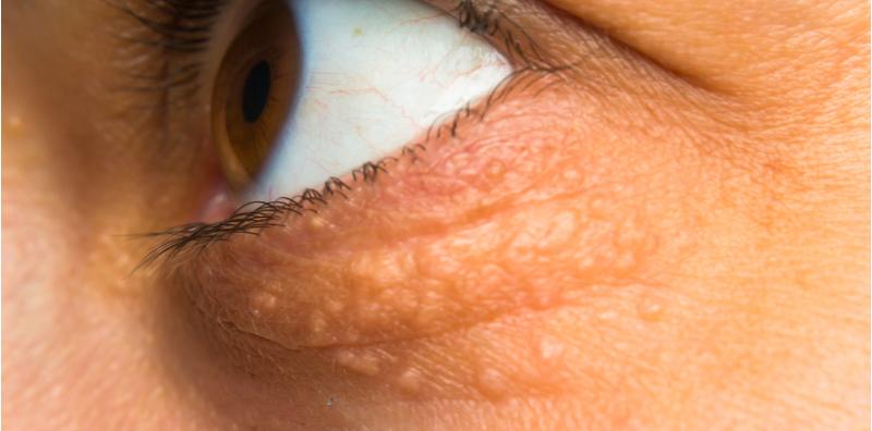 Ada Bintil Kuning Pada Mata? Itu Tandanya Lemak Dalam Badan Tinggi, BAHAYA!