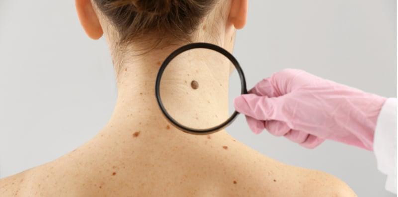 Hidap Kanser Melanoma? Jangan Risau! Ada 5 Kaedah Rawatan Efektif Untuk Anda Cuba