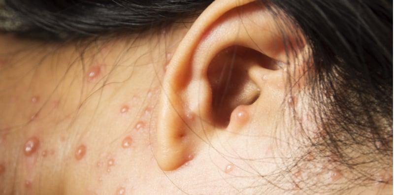 Virus 'Chicken Pox' Boleh Buat Anda Pekak? Ia Mungkin Kesan Sindrom Ini!