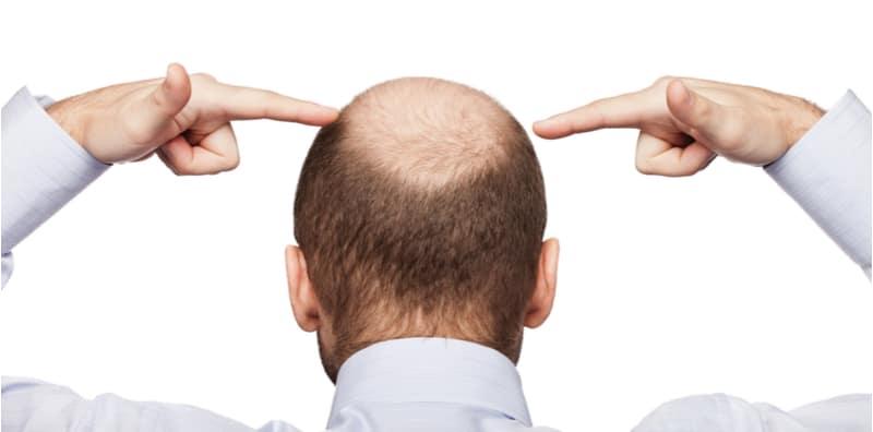 Selain Botak Tengah, Ada 3 Lagi Masalah Rambut Boleh Berlaku Apabila Anda Semakin Tua