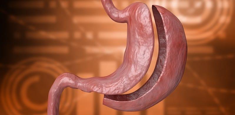 Pernah Dengar Pembedahan Pintasan Perut? Inilah 'Rahsia' Orang Kurus Dalam Sebulan!