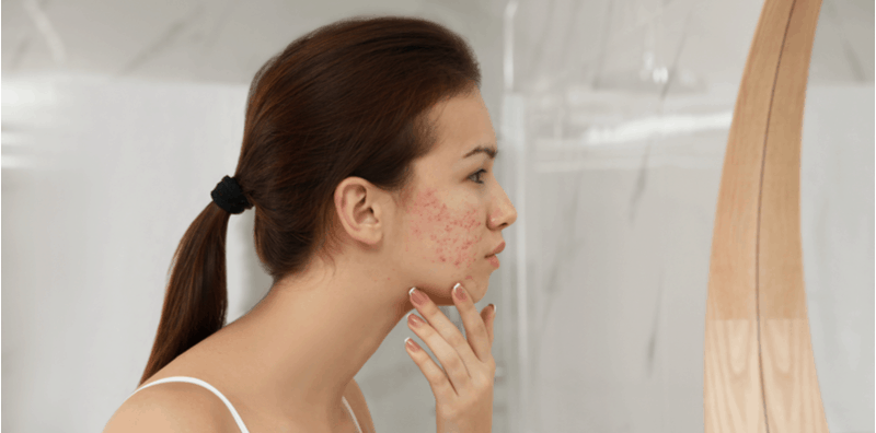 Mengejutkan! Wajah Menggerutu Bukan Sebab Jerawat @ Jeragat, Puncanya Sebab Kutu