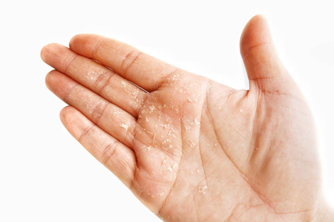 AWAS, Tangan Kering & Mengelupas Mungkin Petanda Masalah Kulit! Ini 4 Penyebab Utama