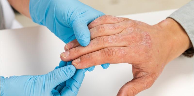 Ekzema, Alahan Makanan & Dermatitis Atopik - Apa Kaitan Di Antara 3 Penyakit Ini?