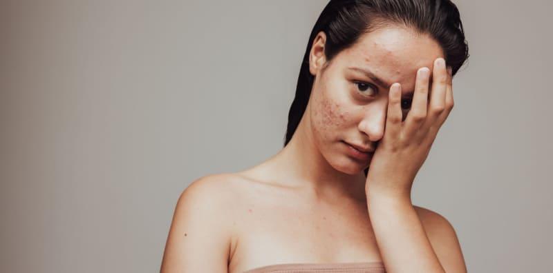 Ikut 7 Cara Ini Kalau Tak Nak Tumbuh Jerawat Di Pipi