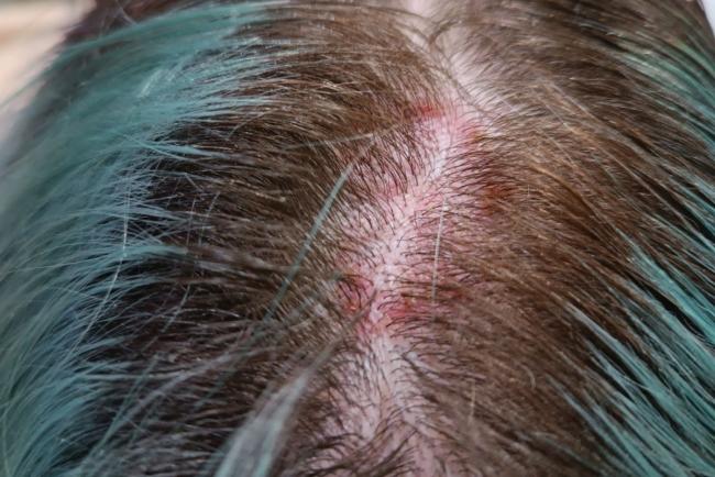 Kulit Kepala Ada Tompok Merah? Jangan Dibiarkan! 6 Kondisi Ini Boleh Jadi Punca