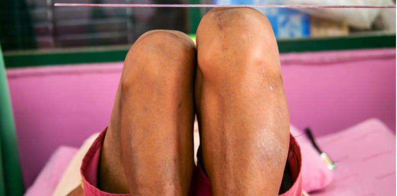 Kaki Pendek Sebelah Punca Anda Tempang? Ada Juga Gejala Lain Yang Boleh Anda Alami