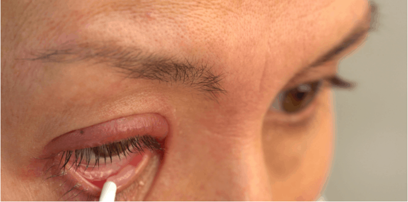 Biasa Muncul Di Luar Kelopak, Tahukah Anda Ada Juga Ketumbit Dalam Mata?