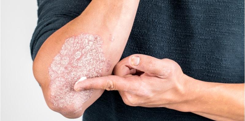 Jom Cuba, Ada Banyak Pilihan Rawatan Bagi Penyakit Kulit Psoriasis!