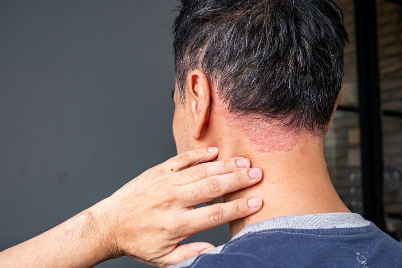 Jaga-Jaga, 4 Jenis Ubat Ini Boleh Jadi Punca Sakit Kulit Psoriasis Bertambah Teruk!