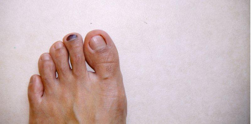 Kuku Kaki Hitam Sebab Selalu Sangat Lakukan Aktiviti Larian? Buat 5 Cara Mudah Ini Untuk Cegah