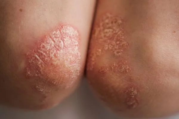 punca penyakit psoriasis