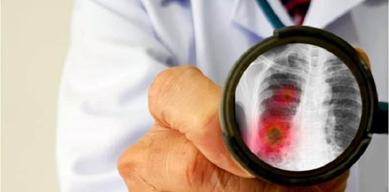 Pesakit COPD Mudah Terkena Pneumonia, Komplikasi Paling Bahaya Hingga Bawa Maut!