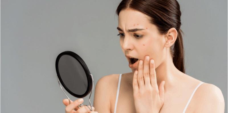 Jerawat & Hormon? Ini Kesannya Pada Kesihatan Wanita