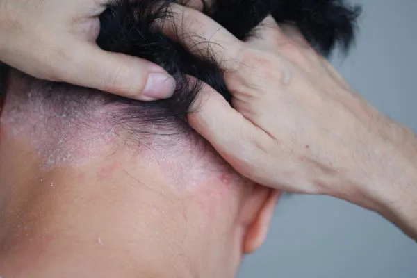 psoriasis kulit kepala