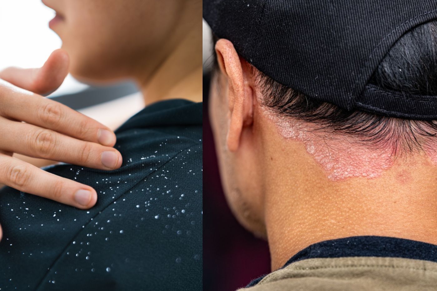 Kelemumur Dan Psoriasis Kulit Kepala: Nampak Sama, Tapi Tak Serupa! Ini Bezanya