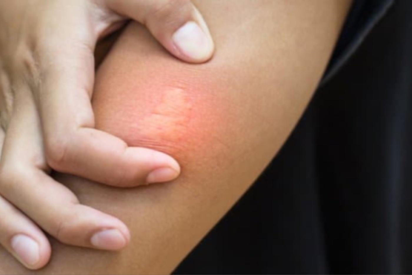 Bantuan Kecemasan Jika Anda Terkena Sengatan Lebah, Ikut Langkah Ini!